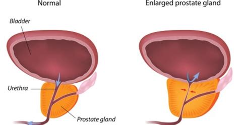 Transurethral resection of the prostate (TURP) .